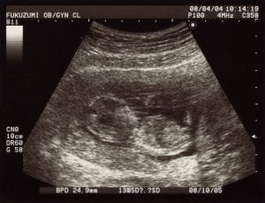 This is how it looks like when performing an ultrasound. Read more about its facts here.
