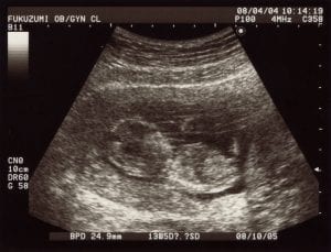 This is in fact how it looks like when performing an ultrasound. Get an ultrasound of your baby now.