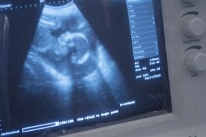 This is how the baby looks like when conducting an ultrasound. Glimpse of an ultrasound of a baby from the clinic.