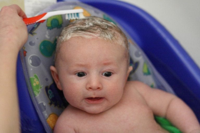 Cradle Cap Symptoms, Causes, Diagnosis & Treatments Family Hype
