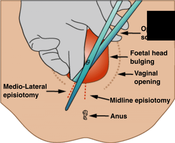 A photo illustrating how the procedure is performed.