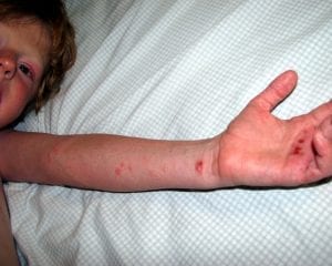 A kid is suffering from red spots and itchiness. Others would recommend to use the best eczema cream to use. It can relieve the itchiness of the kid. It is best as well to consult your dermatologist. You can't always choose the best eczema cream brand as it may not be the best solution to the itchiness of the kid.