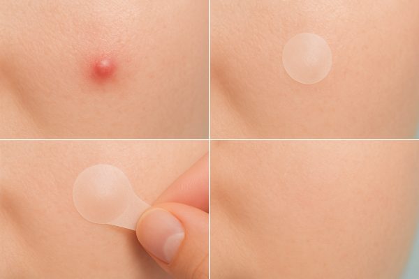 Four macro panels: untreated blemish, patch on, patch lifted, and healed skin.