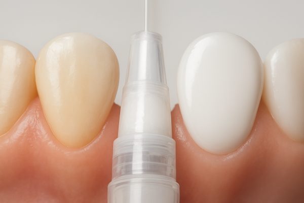 Side-by-side: whitening pen gel on natural tooth versus dental veneer.